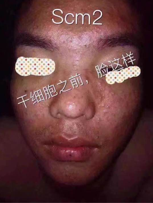 SCM2干细胞 : -5 SCM2干细胞 : -5