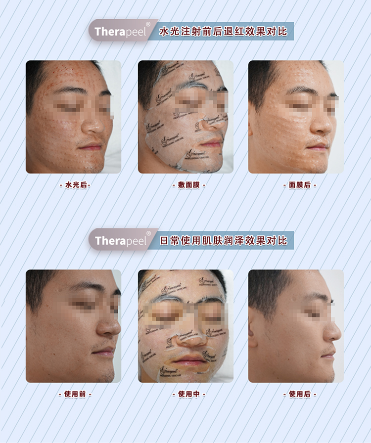 Therapeel秀沐凝医用冷敷贴 : -14