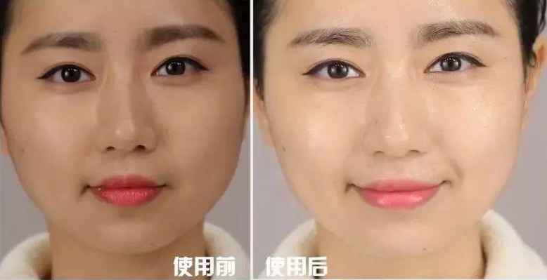 <p>【Chinese name】White Jade Gray Whitening Injection【(White Jade, Cinderella, VC) 【Main raw materials and nutrients】Cysteine, glycine, glutamic acid 【Whether it contains preservatives】No 【Main edible effects】Anti-oxidation, integrated detoxification 【Suitable for people】Aging skin, dark complexion, more fat, easy fatigue.</p> <p>[Application of Korean whitening glutathione] Glutathione has a broad-spectrum detoxification effect. It can not only be used in medicines, but also as a base material for functional foods. It is widely used in functional foods such as anti-aging, enhancing immunity, and anti-tumor. Glutathione (glutathione, GSH) is a tripeptide composed of glutamic acid, cysteine and glycine, containing a sulfhydryl group, which has antioxidant and integrated detoxification effects. The sulfhydryl group on cysteine is the active group of glutathione (so glutathione is often abbreviated as G-SH), which is easy to combine with certain drugs (such as paracetamol), toxins (such as free radicals, iodoacetic acid, mustard gas, lead, mercury, arsenic and other heavy metals), etc., and has an integrated detoxification effect. Therefore, glutathione (especially glutathione in liver cells) can participate in biotransformation, thereby converting harmful toxins in the body into harmless substances and excreting them out of the body. Glutathione can also help maintain the normal function of the immune system.</p> <p>【Three major effects of Cinderella】1. Reduce body fat, increase fat burning rate, increase heat energy formation, promote metabolism, 2. Improve skin, whiten effect, detoxify, prevent skin aging. 3. Strengthen immunity, prevent diabetes and cardiovascular diseases.</p> <p>【White Jade Gray Principle】Cinderella inhibits the increase of active acids through an antioxidant power equivalent to 400 times that of vitamin C and E. With age, the body's antioxidant and detoxification functions decline, and Cinderella injection can improve the antioxidant and detoxification functions. Unlike vitamins, Cinderella injection can penetrate into water-soluble and fat-soluble tissues and has a very strong antioxidant function. The main ingredient of Cinderella injection is a-thiozinic acid, which has the effects of suppressing appetite, promoting energy consumption, and reducing body weight. In addition, vitamin C is also an important antioxidant in the body. Since vitamin C can reversibly hydrogenate or dehydrogenate, vitamin C plays an important role in many redox reactions in the body. For example, the active group of many enzymes is sulfhydryl (-SH), and vitamin C can maintain -SH in a reduced state to maintain the activity of the enzyme; vitamin C can convert oxidized glutathione into reduced glutathione (GSH), reducing hydrogen peroxide (H2O2) produced by the body's metabolism; vitamin C can also protect vitamins A, E and some B vitamins from oxidation. Therefore, when using glutathione, using it together with vitamin C can enhance its efficacy.</p> <p>[Pharmacological action] This product can promote the metabolism of sugar, fat and protein, accelerate the excretion of free radicals, and protect the liver's synthesis, detoxification, inactivation of hormones and other functions. [Hepatoprotective effect] Due to the detoxification and antioxidant ability of glutathione itself, glutathione has an important liver protection effect. Reduced glutathione is used clinically as an important drug ingredient for liver protection. [Clinical application] It is suitable for auxiliary treatment of fatty liver, poisoning and viral hepatitis. [Adverse reactions] Rare nausea, vomiting and headache, rare rash. [Precautions] It is contraindicated for those who are allergic to this product, and it should not be used in combination with vitamin B12, menadione, calcium pantothenate, orotic acid, antihistamine preparations, sulfonamides and tetracycline.</p> <p>[8 major functions of Korean white jade ash whitening injection] ⑴ Detoxification; ⑵ Radiation sickness and radiation protection; ⑶ Protect the liver; ⑷ Anti-allergy; ⑸ Improve the course and symptoms of certain diseases; ⑹ Nourishing the skin; ⑺ Improving vision and eye diseases; ⑻ Anti-aging effect.</p><p>【Main effects】1. Whiten the skin. Reduce melanin, yellow pigment, dullness; 2. Anti-oxidation and aging of body tissues, enhance immunity; 3. Activate cells. Help eliminate toxins, heavy metals (such as lead, mercury, etc.), clean the internal environment, protect the liver and refresh the mind; 4. Protect the skin tissue of the whole body, protect the liver and kidneys (especially suitable for those who stay up late and have poor liver function); 5. Remove spots, restore fair skin, and have the effect of whitening and brightening black, yellow, rough skin and dark patches.</p><p>[Injection method] Method 1: Korean white jade needle, a box of 10 needles, 10 needles is a course of treatment, 1 bottle of white jade with 100ml normal saline or 250ml. White jade + Cinderella has better effect, and 1 bottle of Cinderella should also be matched with 100ml normal saline or 250ml. Cinderella is the partner of white jade. After the injection of white jade, inject Cinderella again after 1 or 2 days, and inject white jade after 1 or 2 days, and so on. Intravenous drip can be used. The slower the injection, the better, 30-40 minutes is appropriate. Basically, there will be a more obvious effect after 3-5 injections. The whitening needle not only has whitening effect, but also has effect on fine lines and spots on the skin. Method 2: White jade, Cinderella and vc are injected together, 1 white jade, 1 Cinderella, 5 vcs are mixed in 200 ml of normal saline, and the injection time is controlled at about 40 minutes, twice a week. Method 3: inject separately, add 2 tubes of VC to 100 ml of saline, the injection time is about 40 minutes, after the injection, wait for 40 minutes, then add 1 tube of Cinderella to 3 VC in 100 ml of saline, the injection time is about 40 minutes, twice a week.</p>