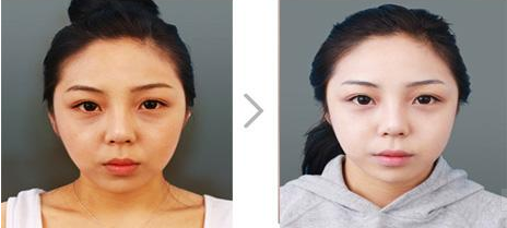 <p>【Chinese name】White Jade Gray Whitening Injection【(White Jade, Cinderella, VC) 【Main raw materials and nutrients】Cysteine, glycine, glutamic acid 【Whether it contains preservatives】No 【Main edible effects】Anti-oxidation, integrated detoxification 【Suitable for people】Aging skin, dark complexion, more fat, easy fatigue.</p> <p>[Application of Korean whitening glutathione] Glutathione has a broad-spectrum detoxification effect. It can not only be used in medicines, but also as a base material for functional foods. It is widely used in functional foods such as anti-aging, enhancing immunity, and anti-tumor. Glutathione (glutathione, GSH) is a tripeptide composed of glutamic acid, cysteine and glycine, containing a sulfhydryl group, which has antioxidant and integrated detoxification effects. The sulfhydryl group on cysteine is the active group of glutathione (so glutathione is often abbreviated as G-SH), which is easy to combine with certain drugs (such as paracetamol), toxins (such as free radicals, iodoacetic acid, mustard gas, lead, mercury, arsenic and other heavy metals), etc., and has an integrated detoxification effect. Therefore, glutathione (especially glutathione in liver cells) can participate in biotransformation, thereby converting harmful toxins in the body into harmless substances and excreting them out of the body. Glutathione can also help maintain the normal function of the immune system.</p> <p>【Three major effects of Cinderella】1. Reduce body fat, increase fat burning rate, increase heat energy formation, promote metabolism, 2. Improve skin, whiten effect, detoxify, prevent skin aging. 3. Strengthen immunity, prevent diabetes and cardiovascular diseases.</p> <p>【White Jade Gray Principle】Cinderella inhibits the increase of active acids through an antioxidant power equivalent to 400 times that of vitamin C and E. With age, the body's antioxidant and detoxification functions decline, and Cinderella injection can improve the antioxidant and detoxification functions. Unlike vitamins, Cinderella injection can penetrate into water-soluble and fat-soluble tissues and has a very strong antioxidant function. The main ingredient of Cinderella injection is a-thiozinic acid, which has the effects of suppressing appetite, promoting energy consumption, and reducing body weight. In addition, vitamin C is also an important antioxidant in the body. Since vitamin C can reversibly hydrogenate or dehydrogenate, vitamin C plays an important role in many redox reactions in the body. For example, the active group of many enzymes is sulfhydryl (-SH), and vitamin C can maintain -SH in a reduced state to maintain the activity of the enzyme; vitamin C can convert oxidized glutathione into reduced glutathione (GSH), reducing hydrogen peroxide (H2O2) produced by the body's metabolism; vitamin C can also protect vitamins A, E and some B vitamins from oxidation. Therefore, when using glutathione, using it together with vitamin C can enhance its efficacy.</p> <p>[Pharmacological action] This product can promote the metabolism of sugar, fat and protein, accelerate the excretion of free radicals, and protect the liver's synthesis, detoxification, inactivation of hormones and other functions. [Hepatoprotective effect] Due to the detoxification and antioxidant ability of glutathione itself, glutathione has an important liver protection effect. Reduced glutathione is used clinically as an important drug ingredient for liver protection. [Clinical application] It is suitable for auxiliary treatment of fatty liver, poisoning and viral hepatitis. [Adverse reactions] Rare nausea, vomiting and headache, rare rash. [Precautions] It is contraindicated for those who are allergic to this product, and it should not be used in combination with vitamin B12, menadione, calcium pantothenate, orotic acid, antihistamine preparations, sulfonamides and tetracycline.</p> <p>[8 major functions of Korean white jade ash whitening injection] ⑴ Detoxification; ⑵ Radiation sickness and radiation protection; ⑶ Protect the liver; ⑷ Anti-allergy; ⑸ Improve the course and symptoms of certain diseases; ⑹ Nourishing the skin; ⑺ Improving vision and eye diseases; ⑻ Anti-aging effect.</p><p>【Main effects】1. Whiten the skin. Reduce melanin, yellow pigment, dullness; 2. Anti-oxidation and aging of body tissues, enhance immunity; 3. Activate cells. Help eliminate toxins, heavy metals (such as lead, mercury, etc.), clean the internal environment, protect the liver and refresh the mind; 4. Protect the skin tissue of the whole body, protect the liver and kidneys (especially suitable for those who stay up late and have poor liver function); 5. Remove spots, restore fair skin, and have the effect of whitening and brightening black, yellow, rough skin and dark patches.</p><p>[Injection method] Method 1: Korean white jade needle, a box of 10 needles, 10 needles is a course of treatment, 1 bottle of white jade with 100ml normal saline or 250ml. White jade + Cinderella has better effect, and 1 bottle of Cinderella should also be matched with 100ml normal saline or 250ml. Cinderella is the partner of white jade. After the injection of white jade, inject Cinderella again after 1 or 2 days, and inject white jade after 1 or 2 days, and so on. Intravenous drip can be used. The slower the injection, the better, 30-40 minutes is appropriate. Basically, there will be a more obvious effect after 3-5 injections. The whitening needle not only has whitening effect, but also has effect on fine lines and spots on the skin. Method 2: White jade, Cinderella and vc are injected together, 1 white jade, 1 Cinderella, 5 vcs are mixed in 200 ml of normal saline, and the injection time is controlled at about 40 minutes, twice a week. Method 3: inject separately, add 2 tubes of VC to 100 ml of saline, the injection time is about 40 minutes, after the injection, wait for 40 minutes, then add 1 tube of Cinderella to 3 VC in 100 ml of saline, the injection time is about 40 minutes, twice a week.</p>