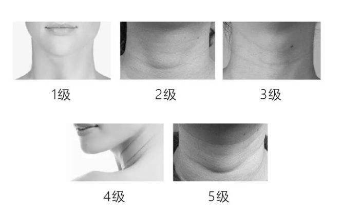 Which treatment option should you choose to fill neck wrinkles?