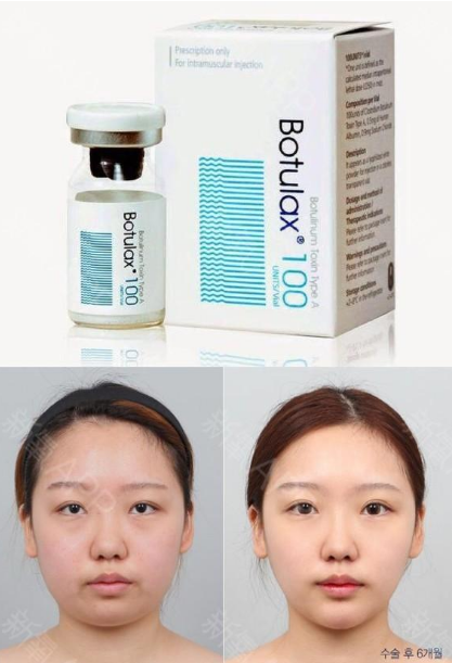 In this age of appearance, I believe that all girls want to have a nice small face, and face-lifting injections are a very popular project now. Moreover, face-lifting injections are micro-plastic surgery, which does not cause wounds and recovers quickly after surgery. They are especially suitable for office workers with a fast pace of life. They can quickly have a small face without being noticed. So, the face-lifting injections that are very popular in Korea now are green poison, white poison, and pink poison. What are the differences between these three types of face-lifting and wrinkle-removing injections? Which one is better? Is it expensive?