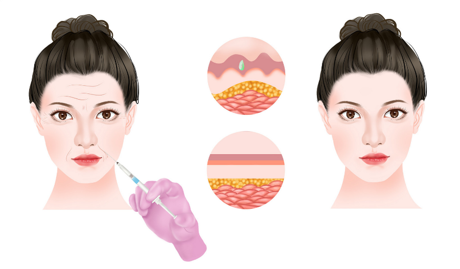 "Light medical beauty" is the general trend, and hyaluronic acid occupies half of the market! -Guangzhou Muning Biotechnology Co., Ltd.