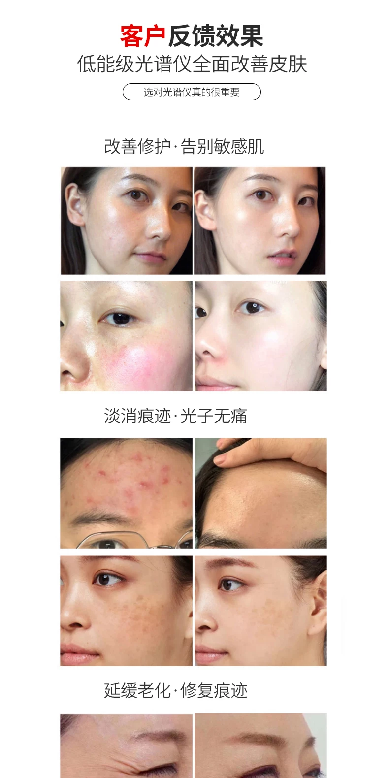 Hcfashion Photon Skin Rejuvenation Device