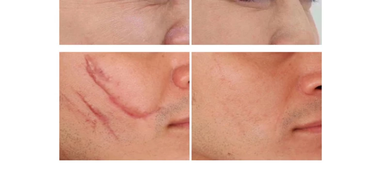 Hcfashion Photon Skin Rejuvenation Device